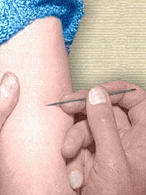 Photo of upper arm, held by doctor in left hand while right hand lightly pricks the skin with a needle. Colorized by todayinsci