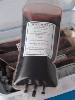 Photo of a standard medical blood drip bag, containing fluid with a blood-like color.