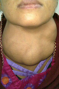 Photo of a woman's neck showing goitre