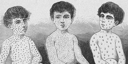 Engraving of 3 children, upper body with the characteristic skin spot patterns of measles, scarlet fever & pustules of smallpox