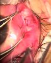 Thumbnail - Eye transplant