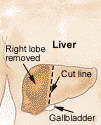 Thumbnail - Living liver donor
