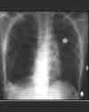 Thumbnail - Family lung operation
