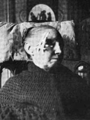 Photo of small radium tubes strapped over area of face of patient, seated, head & shoulders, facing right, b/w