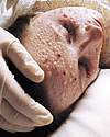 Thumbnail - Last smallpox death