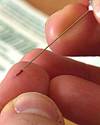 Thumbnail photo showing splinter in a finger tip being removed with a clean pin