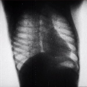 Still from X-ray movie, shows heart, ribcage and spine with view between frontal and lateral.