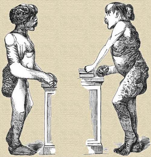 Two sketches by Dr. Treves of Joseph Merrick naked standing full body. One facing R one L show extensive bulky abnormal growths.