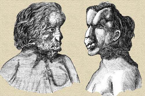 Two sketches by Dr. Treves of head and shoulders of patient, one facing R, one L, showing substantial facial deformities