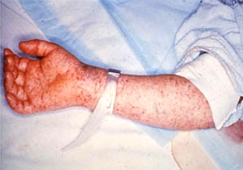 Photo of lower arm and hand showing Rocky Mountain Spotted Fever rash as developed in a later stage